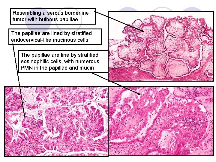 Resembling a serous borderline tumor with bulbous papillae The papillae are lined by stratified