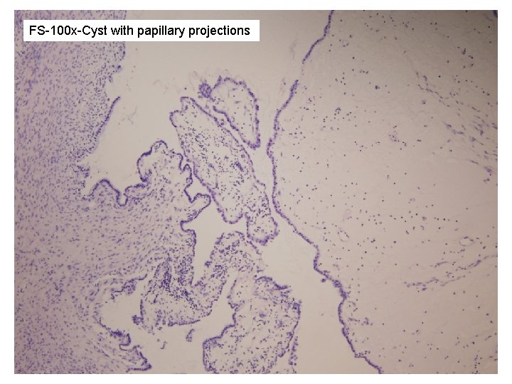 FS-100 x-Cyst with papillary projections 