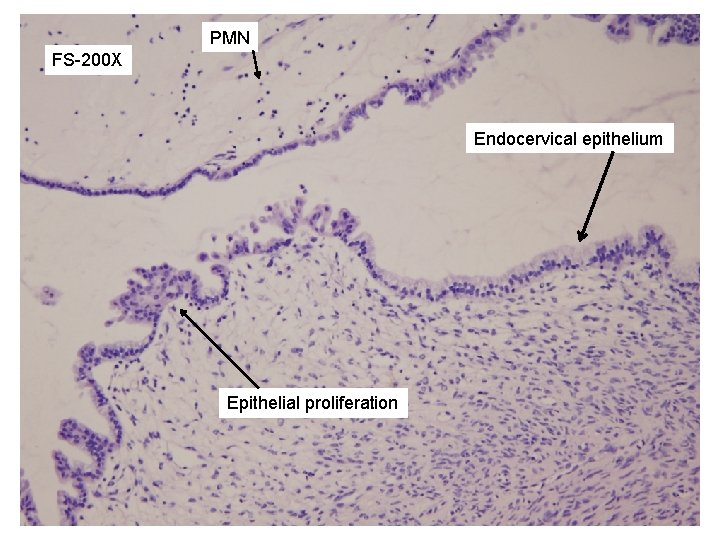 PMN FS-200 X Endocervical epithelium Epithelial proliferation 