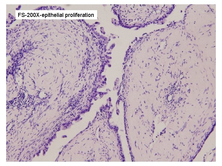 FS-200 X-epithelial proliferation 