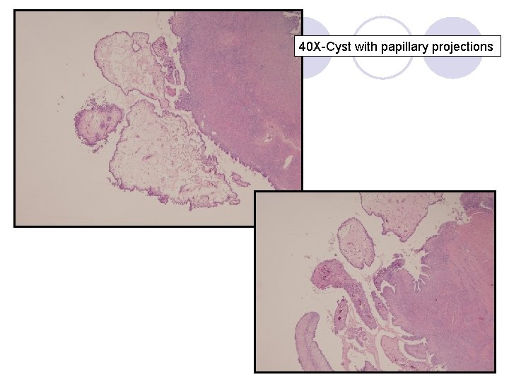 40 X-Cyst with papillary projections 