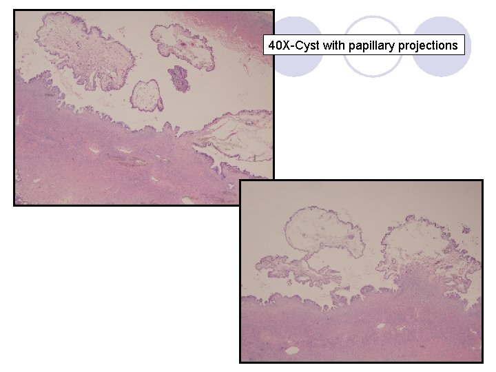 40 X-Cyst with papillary projections 