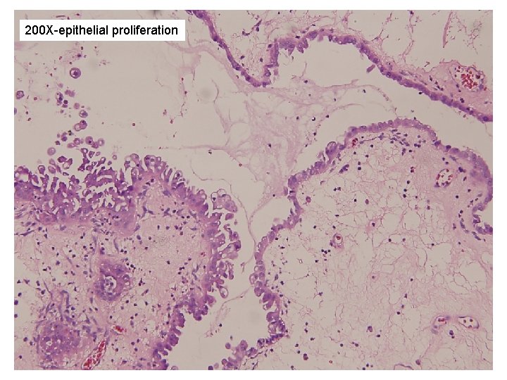 200 X-epithelial proliferation 