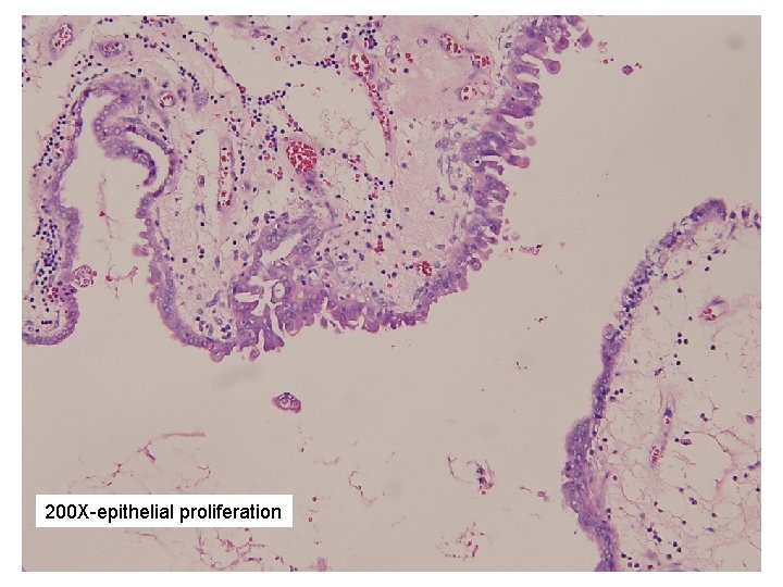 200 X-epithelial proliferation 