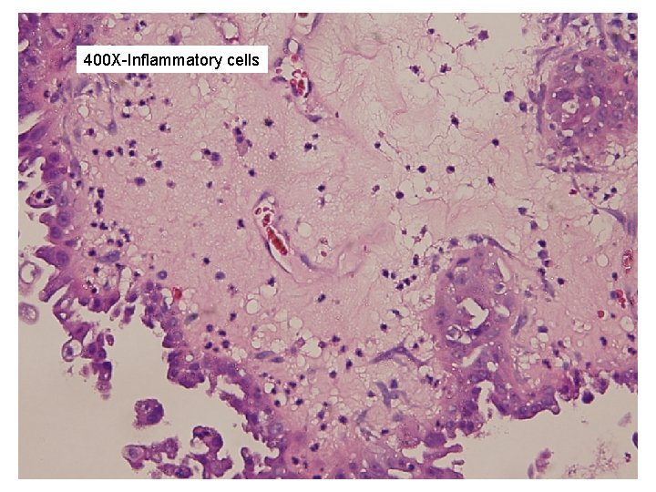 400 X-Inflammatory cells 