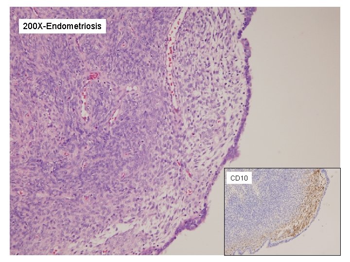 200 X-Endometriosis CD 10 