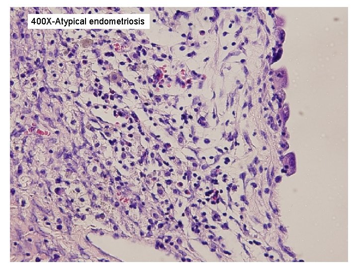 400 X-Atypical endometriosis 