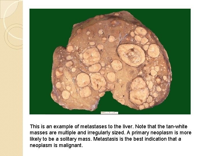 This is an example of metastases to the liver. Note that the tan-white masses