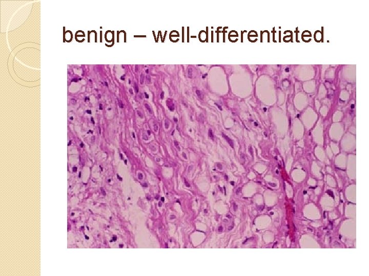 benign – well-differentiated. 