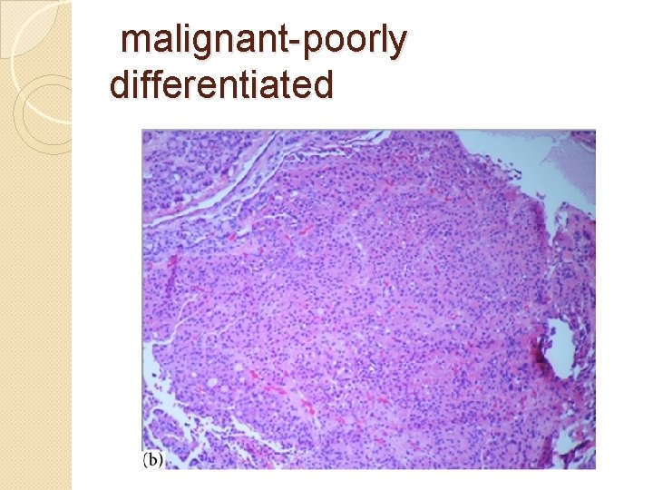 malignant-poorly differentiated 