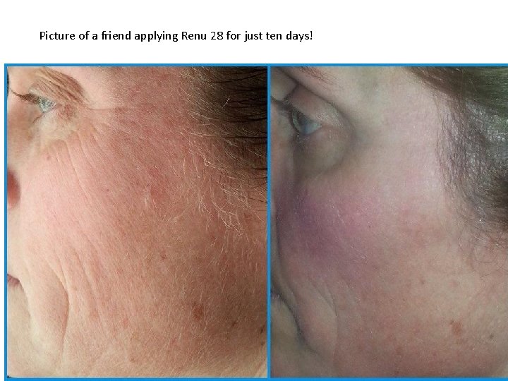 Picture of a friend applying Renu 28 for just ten days! 