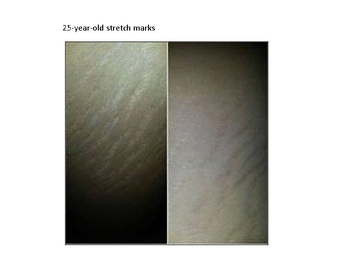 25 -year-old stretch marks 