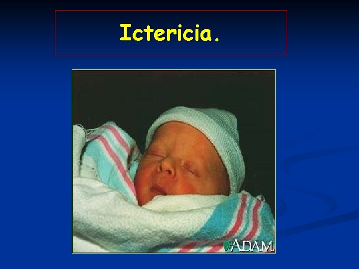 Ictericia. 