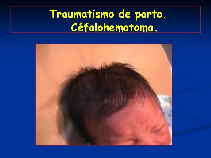 Traumatismo de parto. Céfalohematoma. 