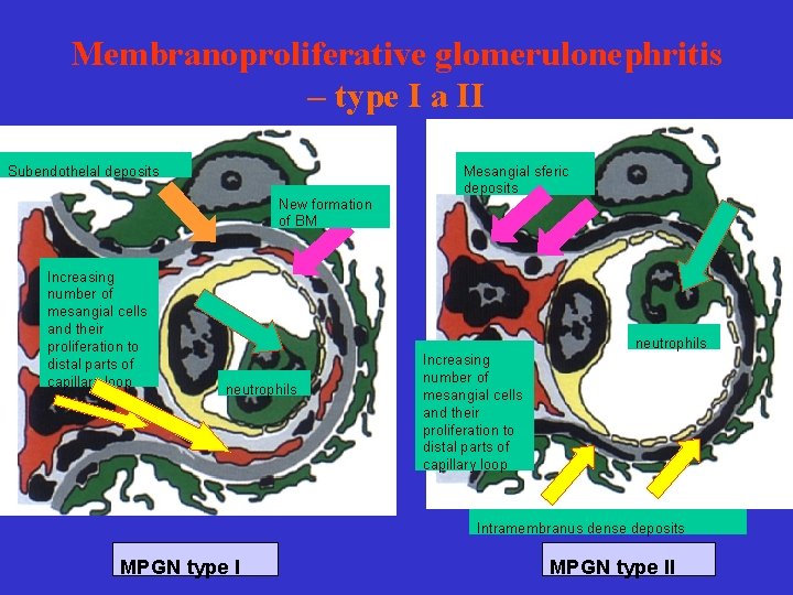 Membranoproliferative glomerulonephritis – type I a II Subendothelal deposits New formation of BM Increasing