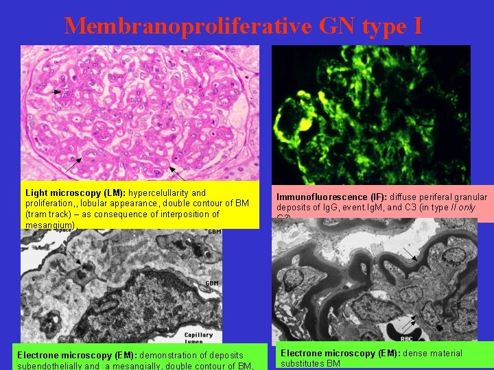 Membranoproliferative GN type I Light microscopy (LM): hypercelullarity and proliferation, , lobular appearance, double