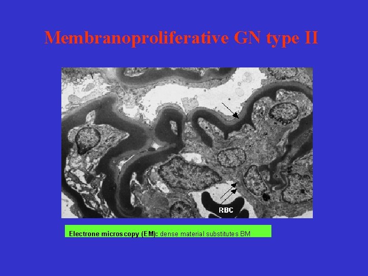 Membranoproliferative GN type II Electrone microscopy (EM): dense material substitutes BM 