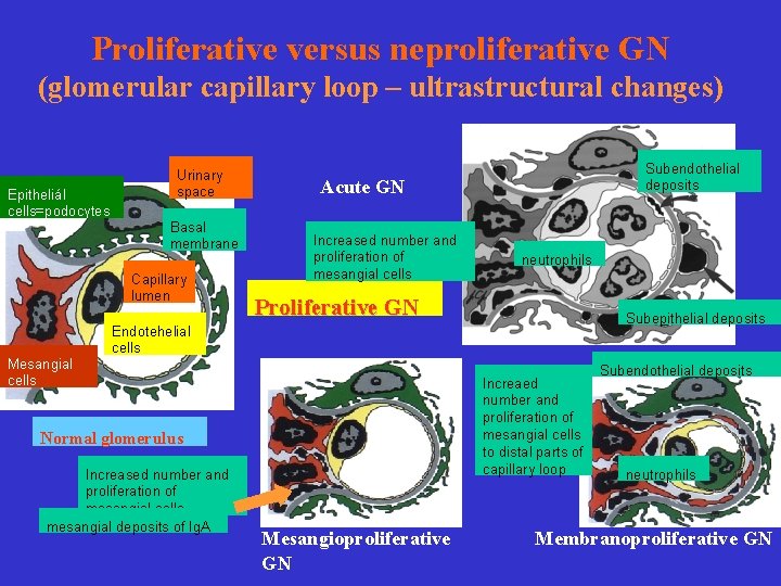 Proliferative versus neproliferative GN (glomerular capillary loop – ultrastructural changes) Epitheliál cells=podocytes Urinary space