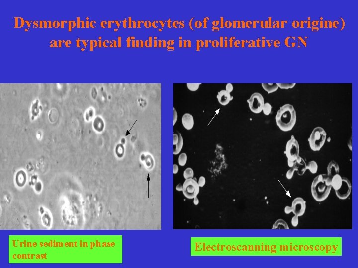 Dysmorphic erythrocytes (of glomerular origine) are typical finding in proliferative GN Urine sediment in