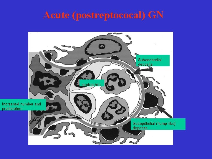 Acute (postreptococal) GN Subendotelial deposits neutrophils Increased number and proliferation Subepithelial (hump-like) deposits 