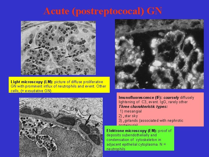 Acute (postreptococal) GN Light microscopy (LM): picture of diffuse proliferative GN with prominent influx
