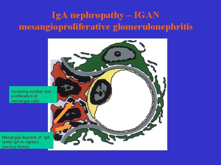 Ig. A nephropathy – IGAN mesangioproliferative glomerulonephritis Increaing number and proliferation of mesangial cells