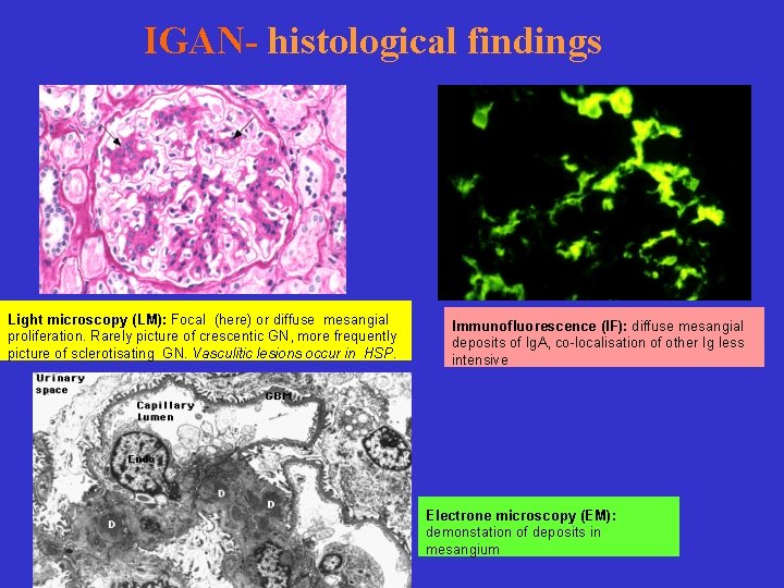 IGAN- histological findings Light microscopy (LM): Focal (here) or diffuse mesangial proliferation. Rarely picture