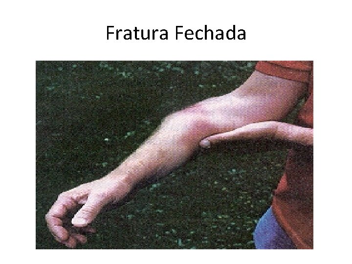 Fratura Fechada 