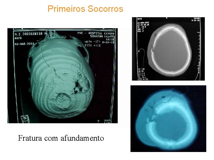 Primeiros Socorros Fratura com afundamento 