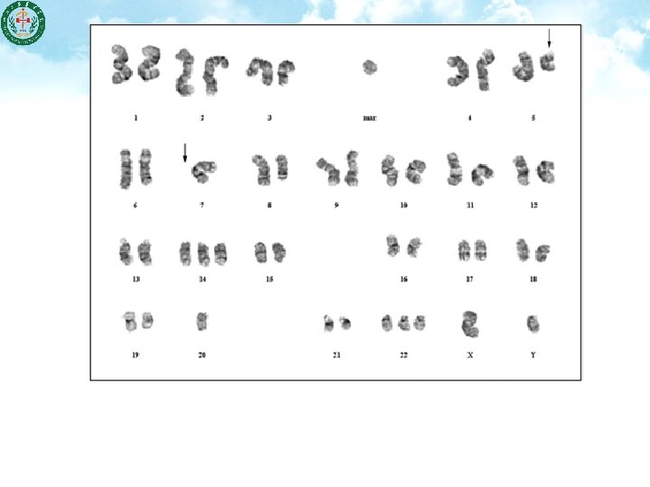 Figure Complex karyotype of an MDS patient. This karyotype from a case of RAEB-2