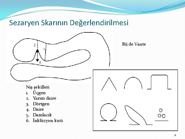 Sezaryen Skarının Değerlendirilmesi Bij de Vaate Niş şekilleri 1. Üçgen 2. Yarım daire 3.