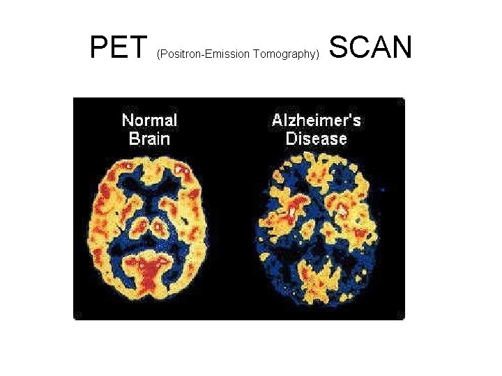 PET (Positron-Emission Tomography) SCAN 