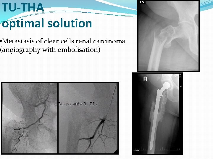 TU-THA optimal solution • Metastasis of clear cells renal carcinoma (angiography with embolisation) 