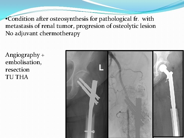  • Condition after osteosynthesis for pathological fr. with metastasis of renal tumor, progresion