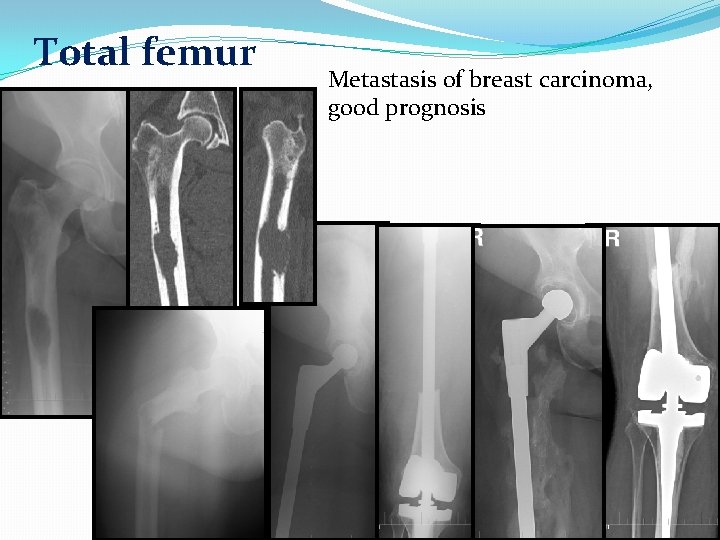 Total femur Metastasis of breast carcinoma, good prognosis 