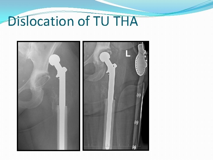 Dislocation of TU THA 