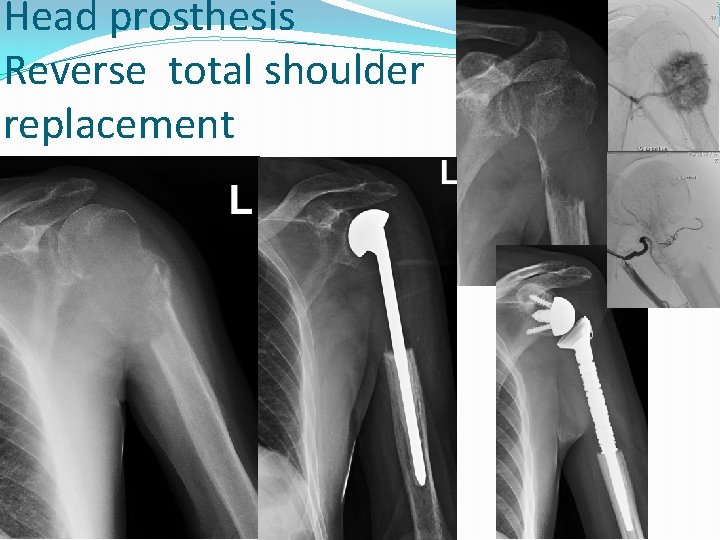 Head prosthesis Reverse total shoulder replacement 