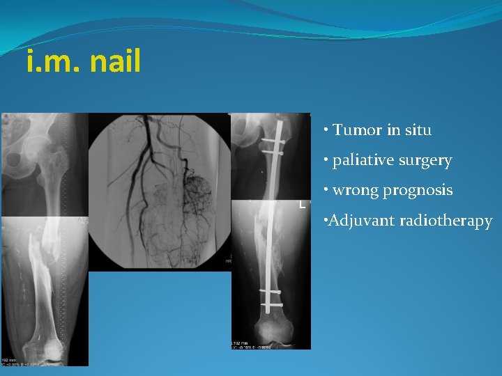 i. m. nail • Tumor in situ • paliative surgery • wrong prognosis •