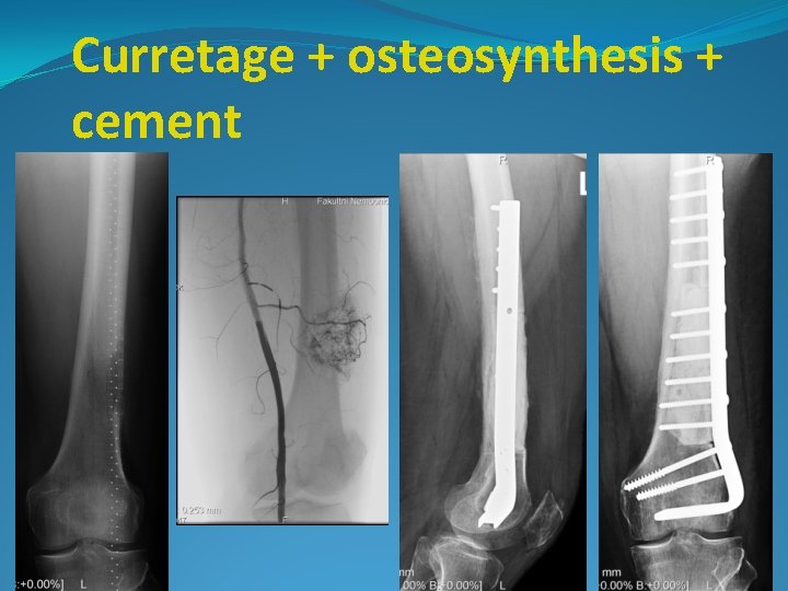 Curretage + osteosynthesis + cement 