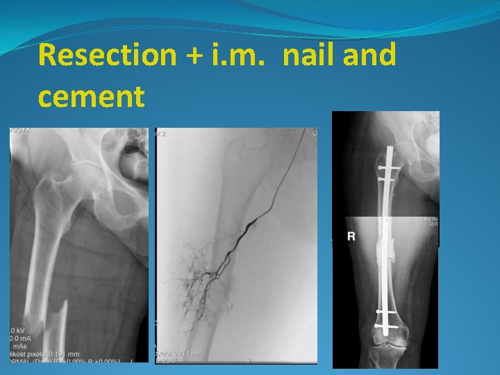 Resection + i. m. nail and cement 