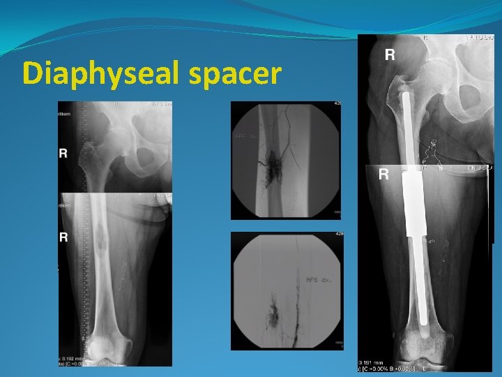 Diaphyseal spacer 