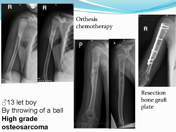 Orthesis chemotherapy ♂13 let boy By throwing of a ball High grade osteosarcoma Resection