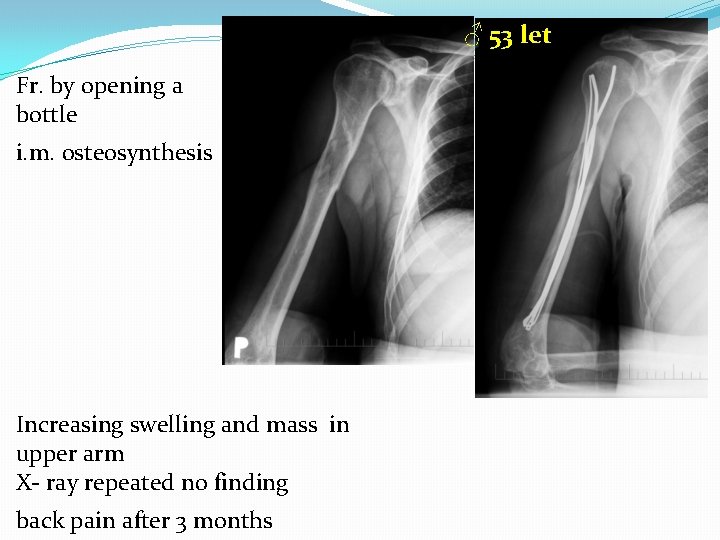 ♂ 53 let Fr. by opening a bottle i. m. osteosynthesis Increasing swelling and