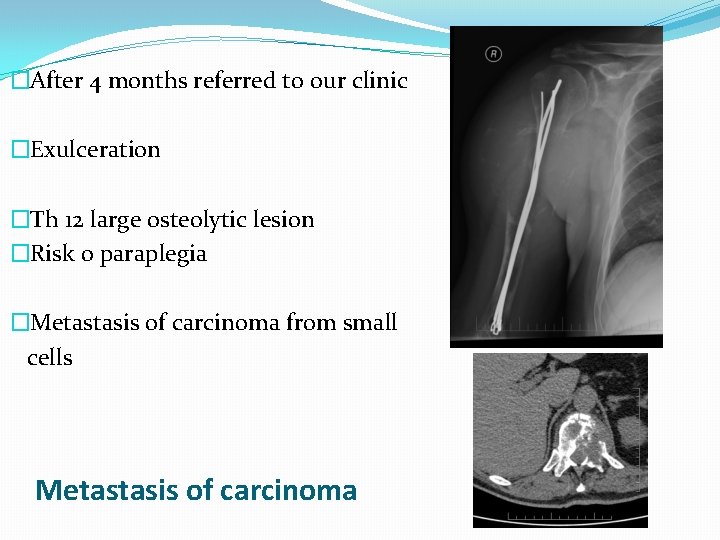 �After 4 months referred to our clinic �Exulceration �Th 12 large osteolytic lesion �Risk