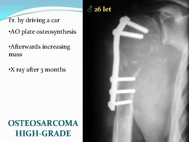 ♂ 26 let Fr. by driving a car • AO plate osteosynthesis • Afterwards