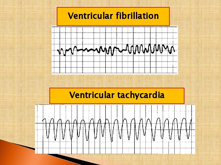 Ventricular fibrillation Ventricular tachycardia 