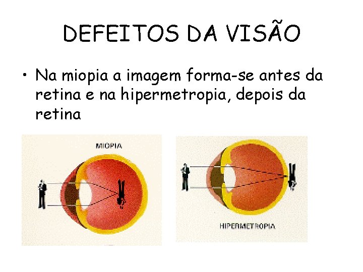 DEFEITOS DA VISÃO • Na miopia a imagem forma-se antes da retina e na