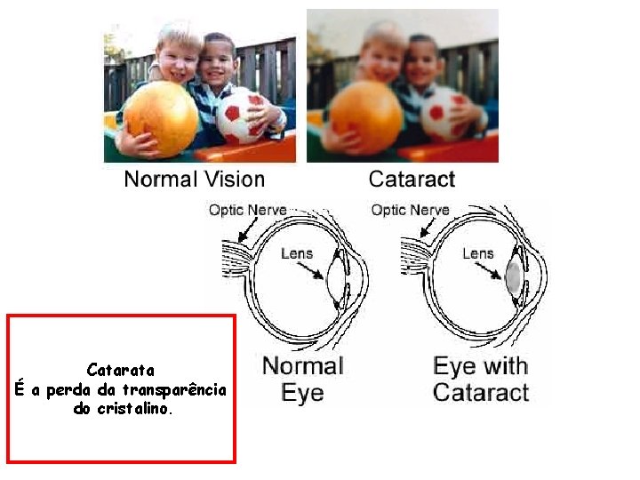 Catarata É a perda da transparência do cristalino. 
