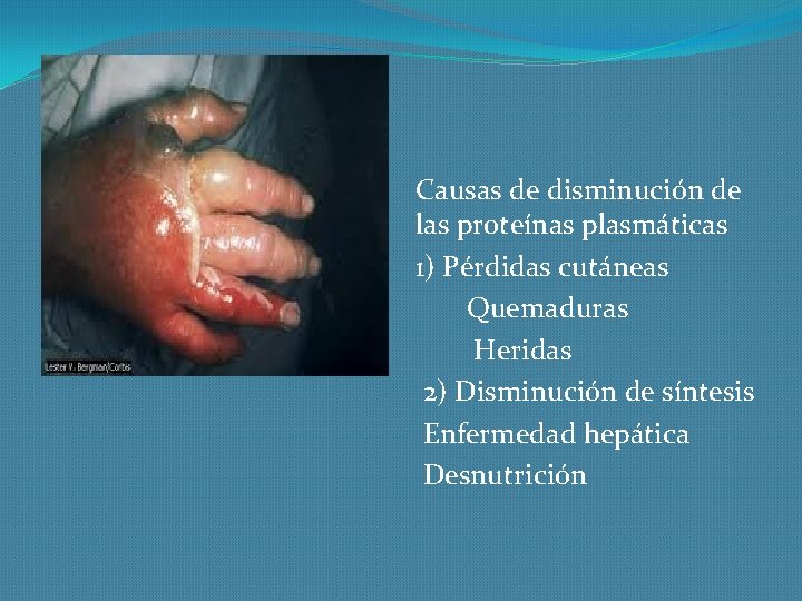 Causas de disminución de las proteínas plasmáticas 1) Pérdidas cutáneas Quemaduras Heridas 2) Disminución