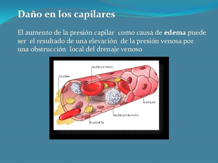 Daño en los capilares El aumento de la presión capilar como causa de edema